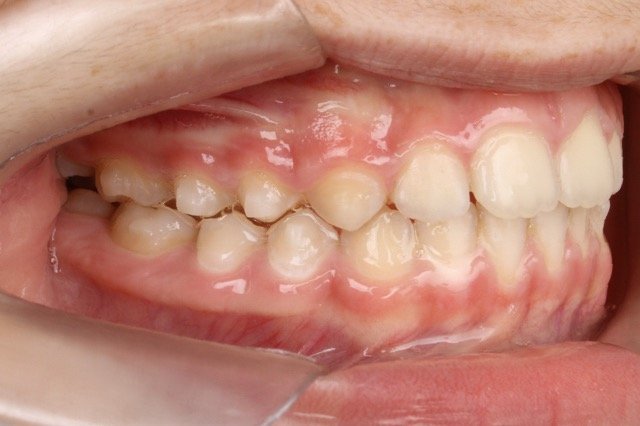 guilherme-invisalign1