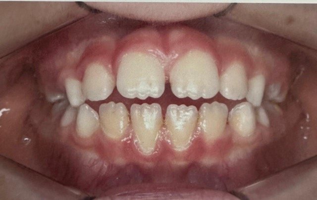 guilherme-invisalign2