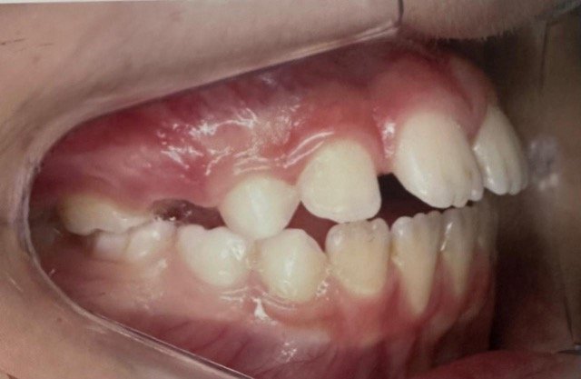 guilherme-invisalign3
