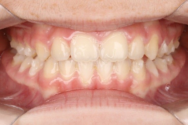 guilherme-invisalign4